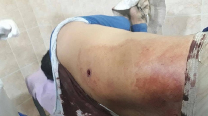 Los heridos producto del nuevo enfrentamiento con la Policía. Fotos: Facebook Yungueños por el Mundo