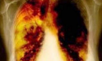 Fármaco contra cáncer de pulmón. Imagen ilustrativa. Foto: AGENCIAS