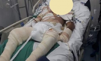Edson Veizaga Pérez, tenía el 80% de su cuerpo quemado/Foto. RRSS