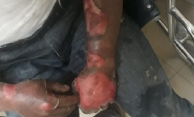 El hombre esta internado con graves quemaduras/Foto. KA