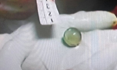 Explicó que en presencia del equipo multidisciplinario se extrajo una canica transparente. Foto: RRSS