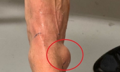 El futbolista sufrió este miércoles una  rotura de tobillo/Foto. RRSS