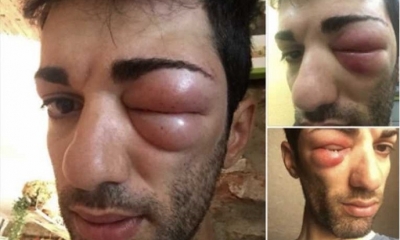 Danilo Celano, su ojo izquierdo quedó hinchado por una picadura de insecto. Foto: Emol.com