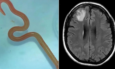 La mujer había ingresado en el hospital tras tres meses de olvidos y depresión. Los escáneres mostraron cambios en su cerebro.