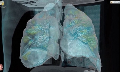 Según el Dr. Keith Mortman existe una posibilidad de daño permanente a los pulmones de quienes sobreviven al Covid-19. 