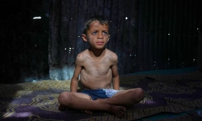 Ahmed El-Sheikh Eid, un niño de 7 años que presenta señales de desnutrición