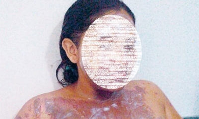 La mujer tiene el 40% de su cuerpo quemado/Foto. RRSS