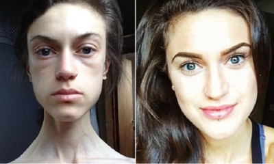 Emelle Lewis, de 22 años, lucha contra este desorden alimenticio desde que es una adolescente