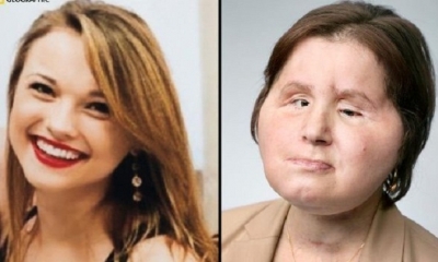 Katie se convirtió en la persona más joven en ser sometida a un trasplante de rostro