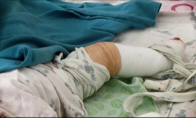 Fallece niña quemada por su padre; hermano lucha por su vida. Imagen referencial. (Archivo)