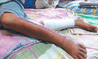 Las quemaduras de segundo grado que sufrió lo enviaron a un centro de salud para que reciba atención médica. Foto: El Deber