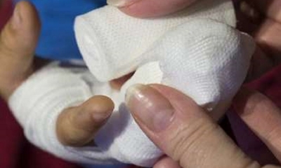 Niño que fue quemado por su madre espera visa para viajar y someterse a más cirugías
