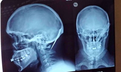 La radiografía del cráneo de Oscar.