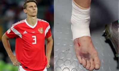 El jugador terminó el partido con una fractura/Foto. Kandire