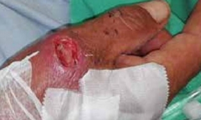 Las esquirlas se incrustaron en el cuerpo de las mujeres/Foto. RRSS