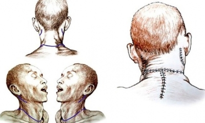 Los neurocirujanos han encontrado en China apoyo para sus experimentos, criticados en algunos sectores científicos por cuestiones éticas y morales.