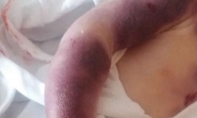 El recién nacido murió por quemaduras de tercer grado/Foto. RRSS