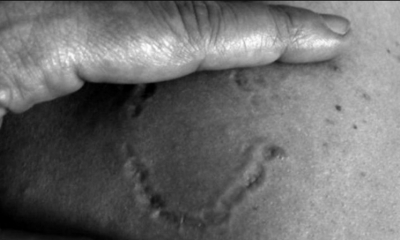 Una chica, menor de edad, fue mordida por su ex pareja tras un fuerte altercado. El agresor la tomó de los brazos, la zamarreó y le provocó una herida