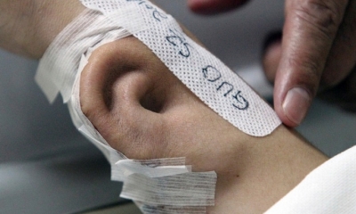 Una oreja cultivada en el brazo de un paciente que perdió el pabellón auditivo en un accidente, China. Foto: RT