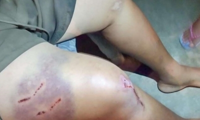 El hombre quedo con Heridas por el ataque del perro.