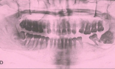 Referencial. Tomografía de un tumor similar en la esquina inferior derecha de un paciente. | Fuente: N+1