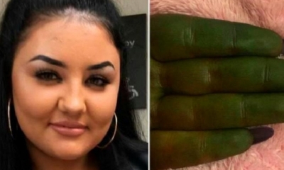 Una joven aplicó en todo su cuerpo un bronceador barato, sin saber que su piel tomaría un color verdoso. Foto: La República